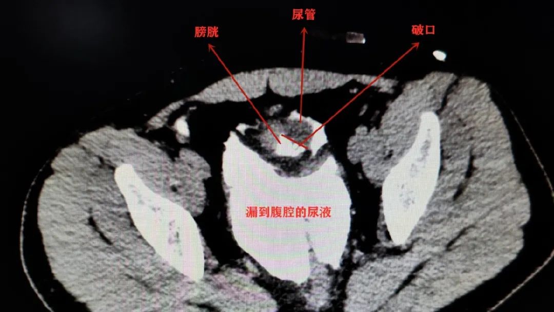 憋尿会憋“死”人？真的！