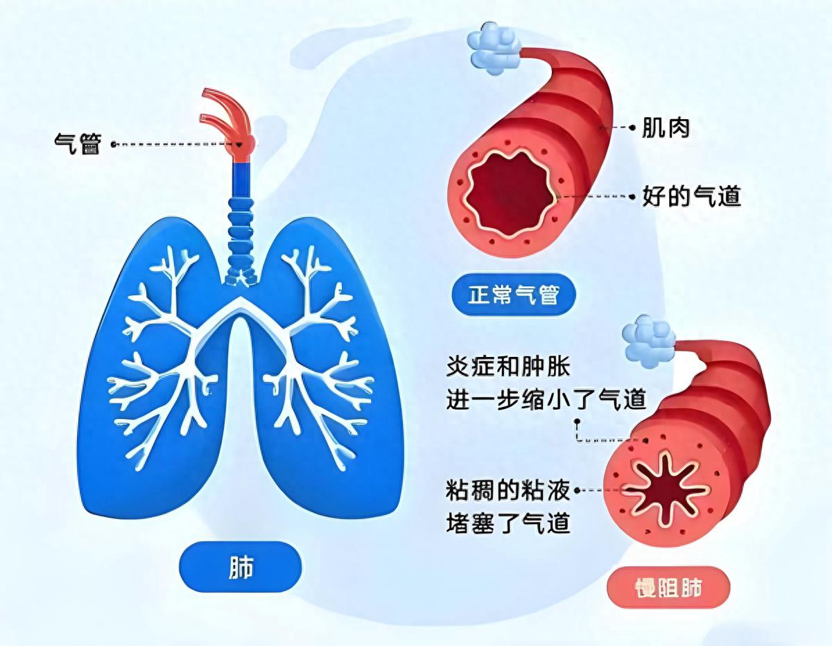 成都中医哮喘医院姚宏胤医生解析：慢阻肺什么时候治疗最好？